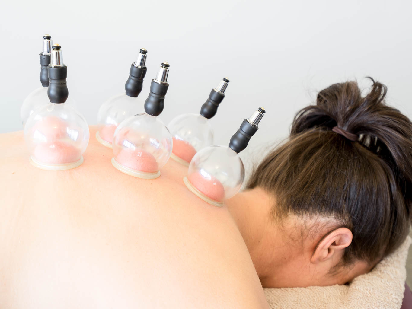 Cupping Therapy