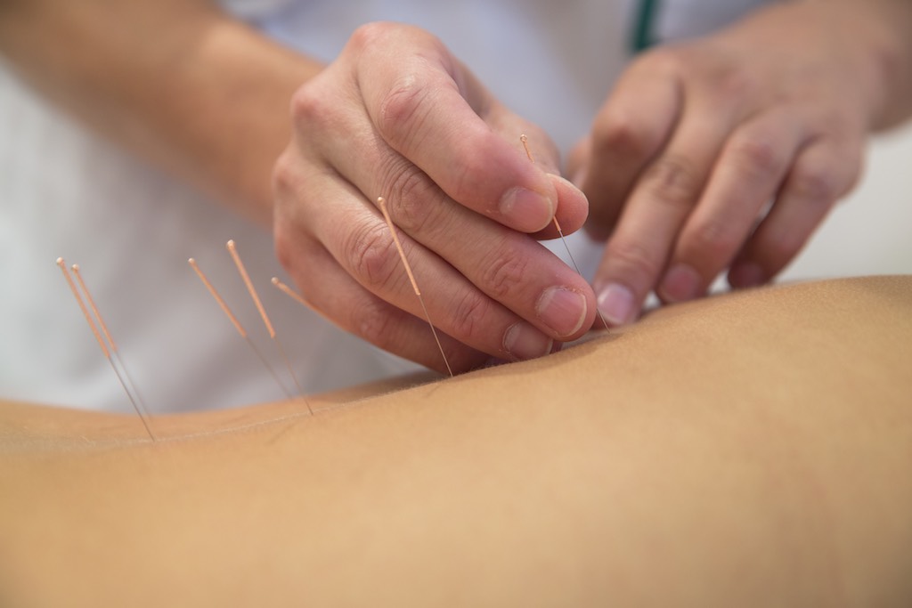 dry needling